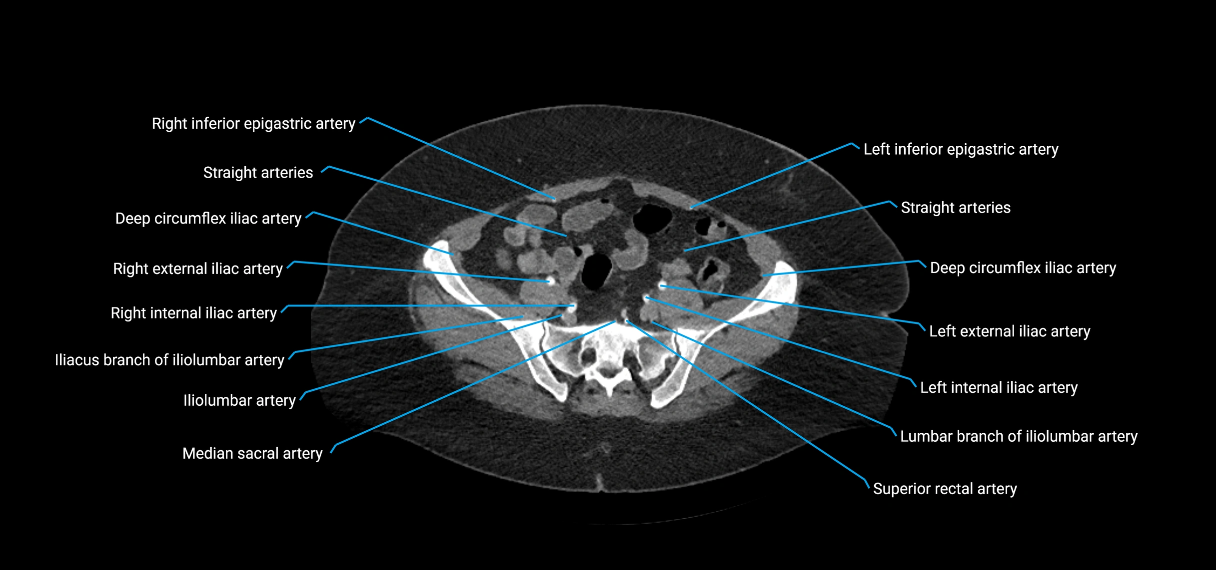 CTA abdomen axial cross sectional anatomy labelled image_190 (2).webp